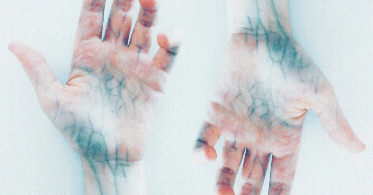 Cover Image for Understanding Sclerotherapy: A Guide to Treating Varicose Veins
